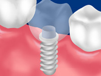 インプラント治療