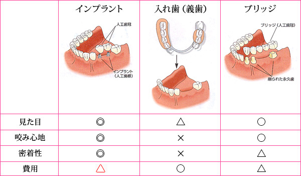 インプラント・入れ歯（義歯）・ブリッジの比較表