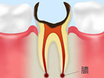 歯根まで達した虫歯